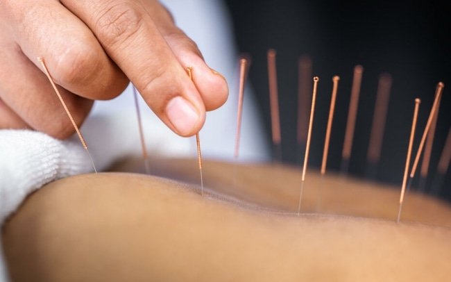 Introduction à l’Acupuncture : L’art de l’équilibre par le Qi